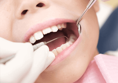 歯垢(プラーク)・歯石の除去イメージ